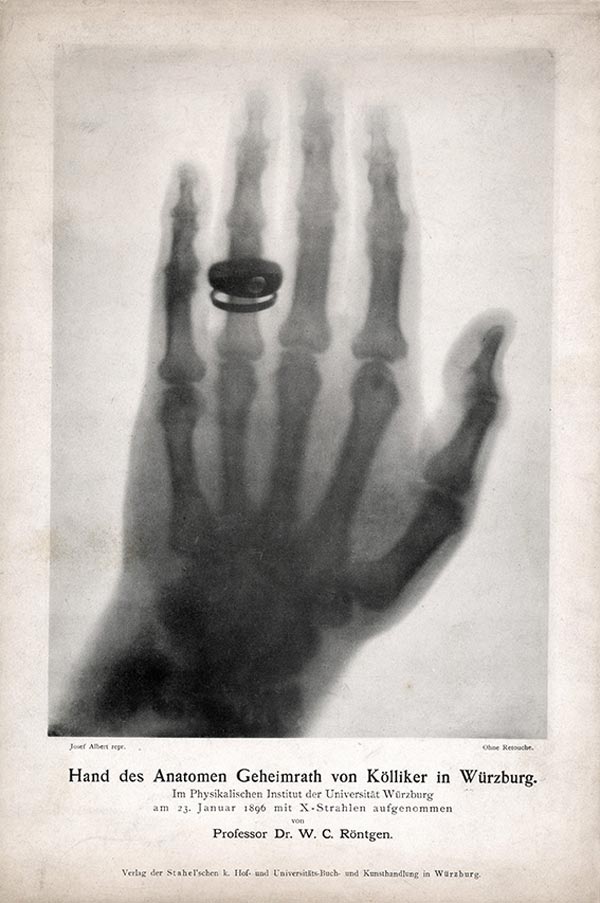 Röntgenaufnahme der Hand von Albert von Kölliker.